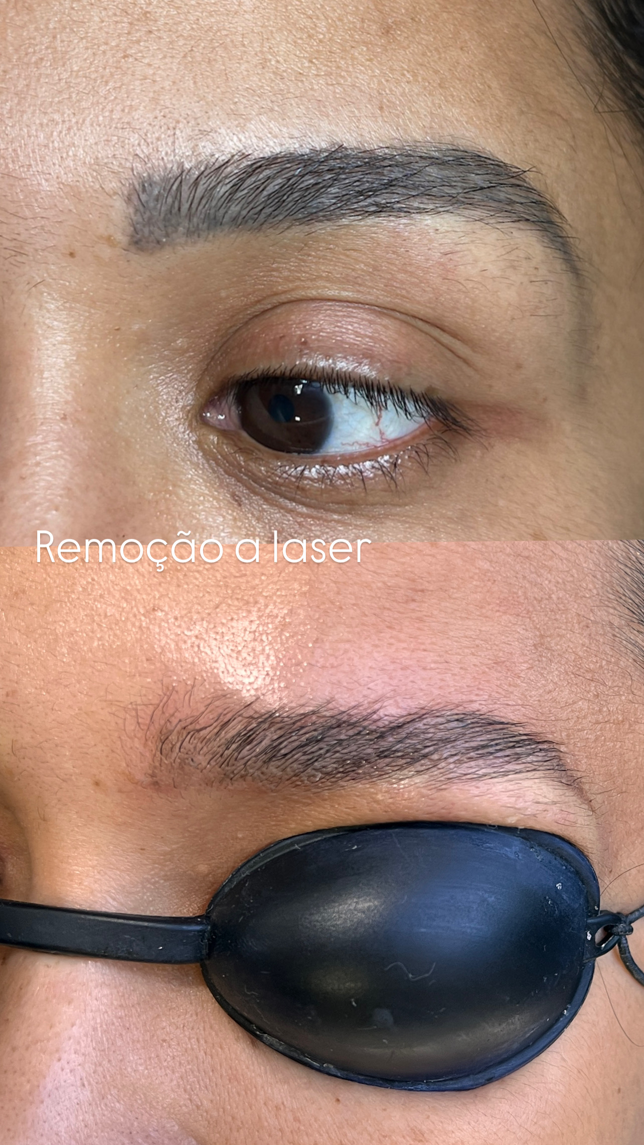 Sessão de remoção a laser em andamento