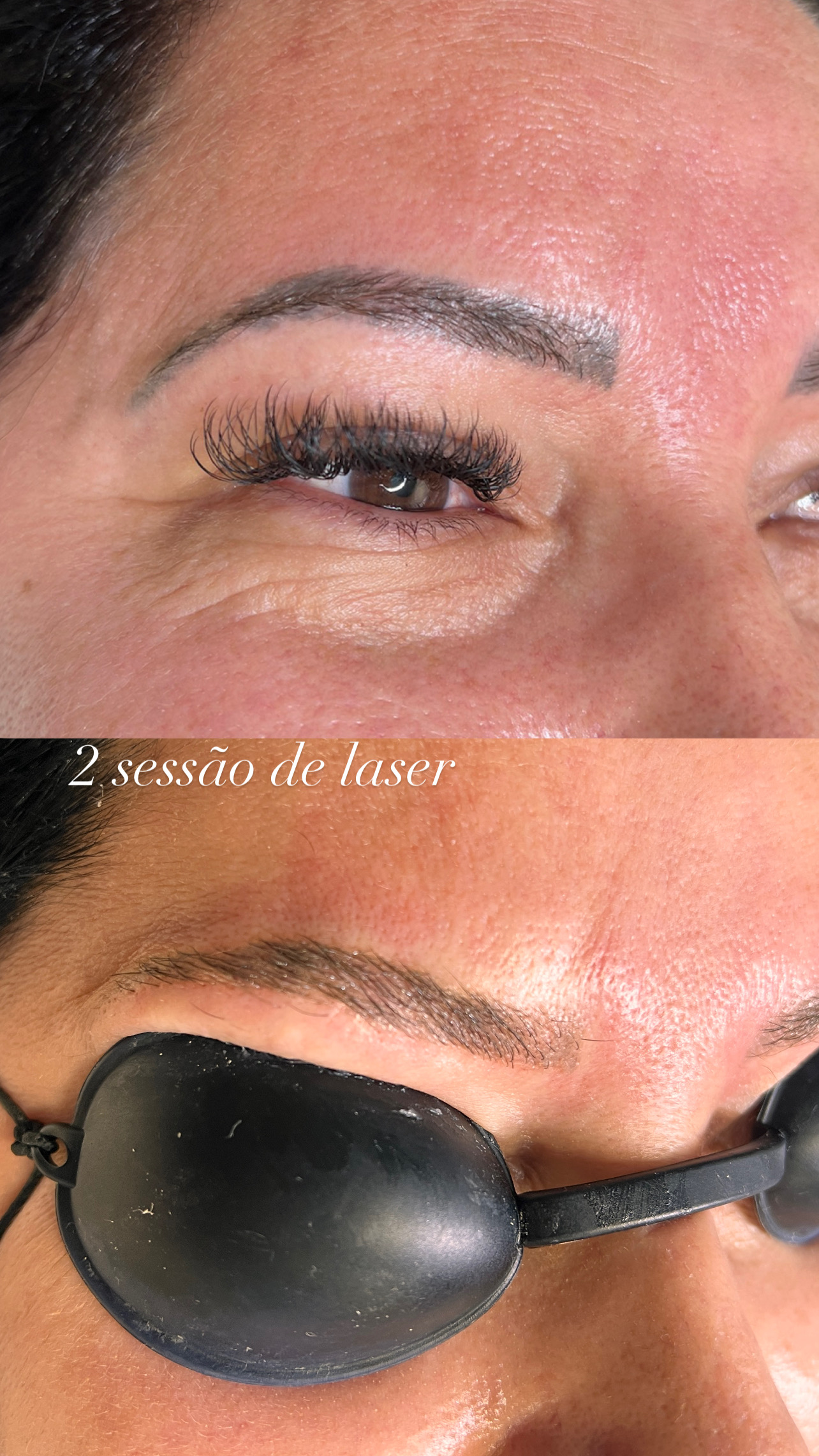 Antes e depois remoção a laser 2