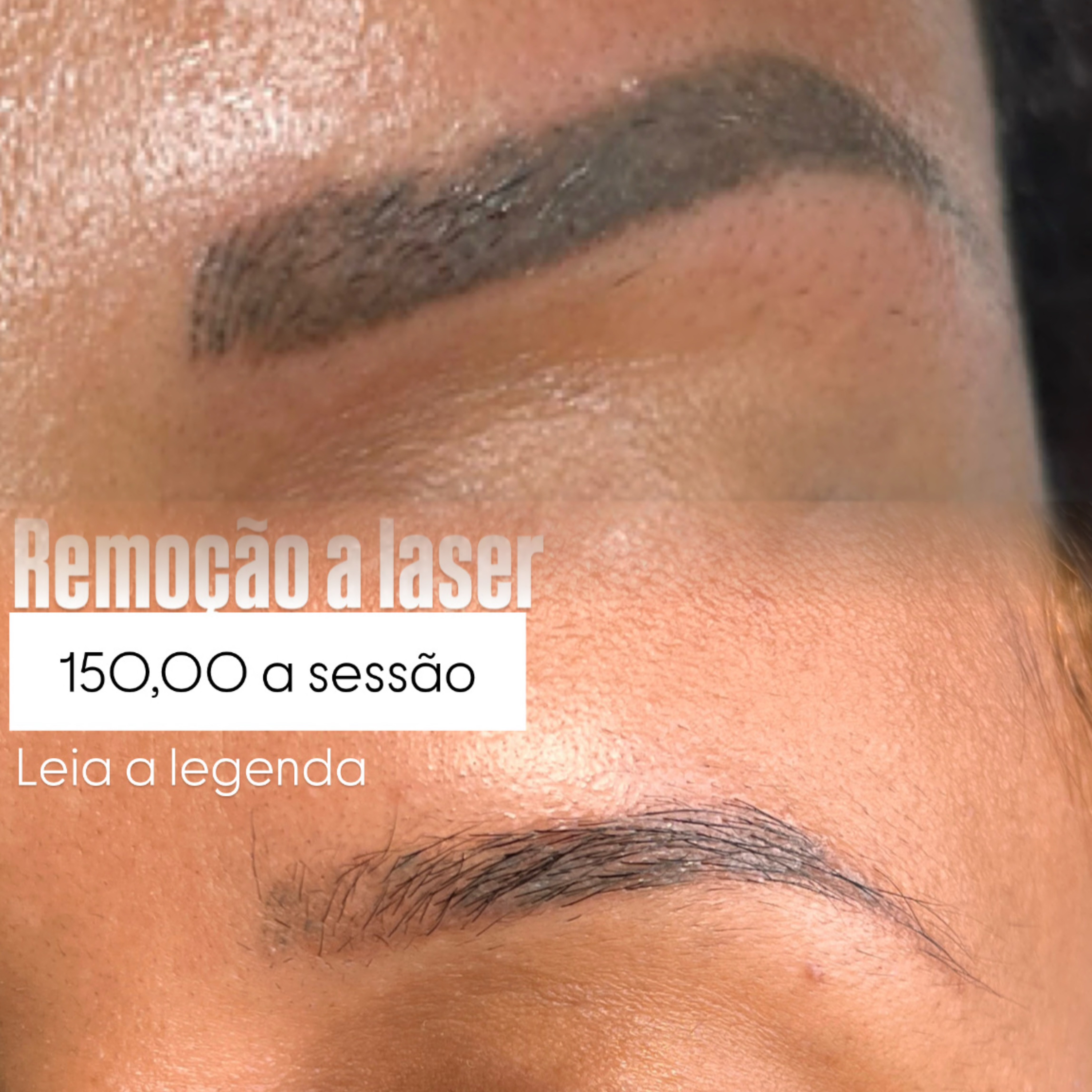 Antes e depois remoção a laser 4