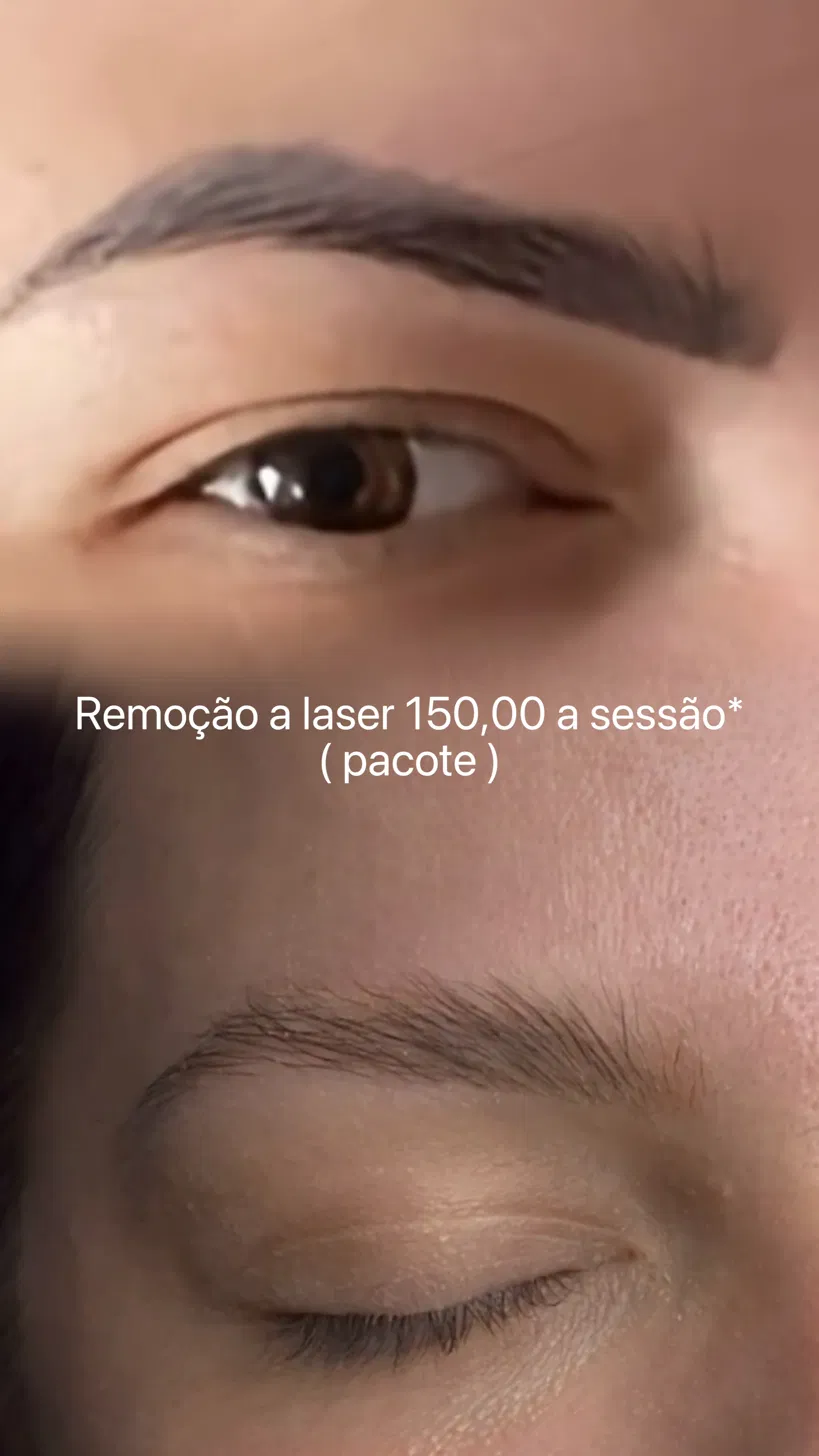 Antes e depois remoção a laser 5