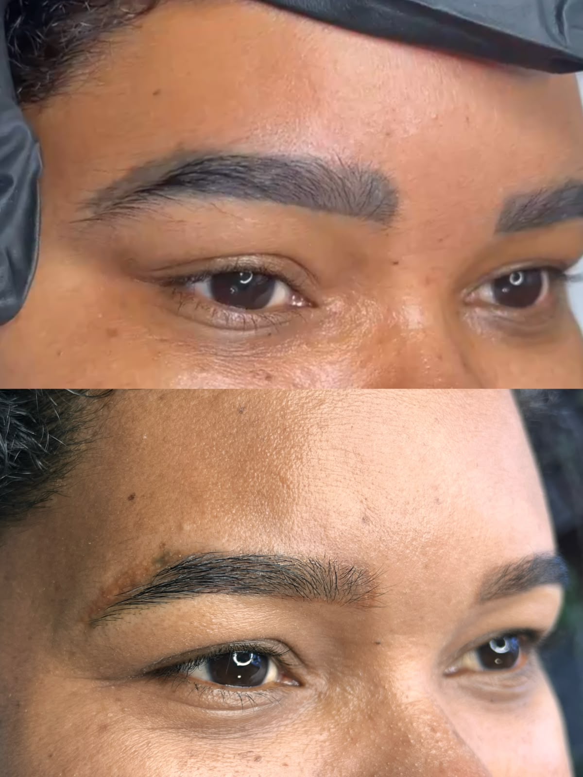 Antes e depois remoção a laser 3
