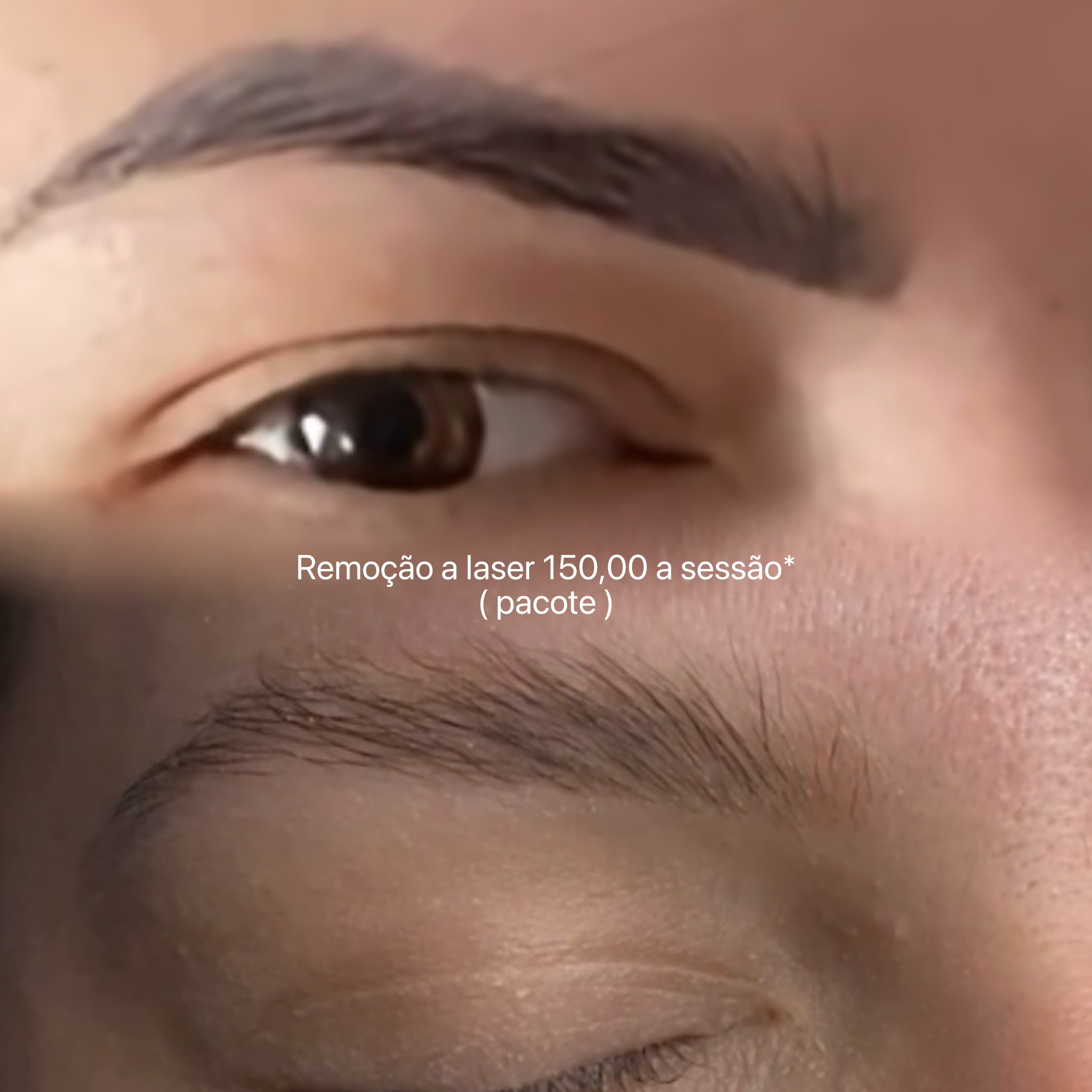 Antes e depois remoção a laser 7