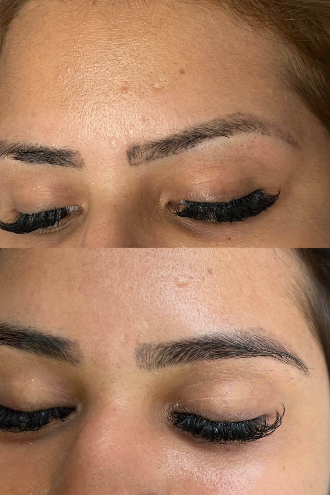 Antes e depois de remoção a laser de micropigmentação